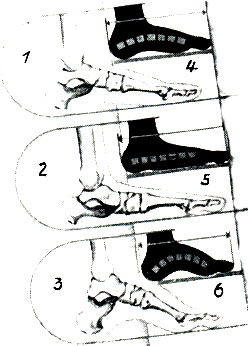Рис. 406. Положение костей при нормальной, плоской и полой ступне