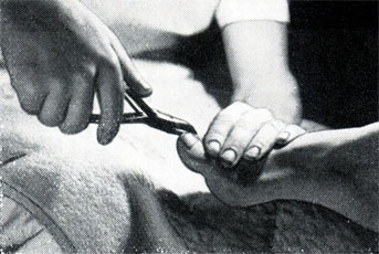 Рис. 411. Правильное положение при подрезании ногтя